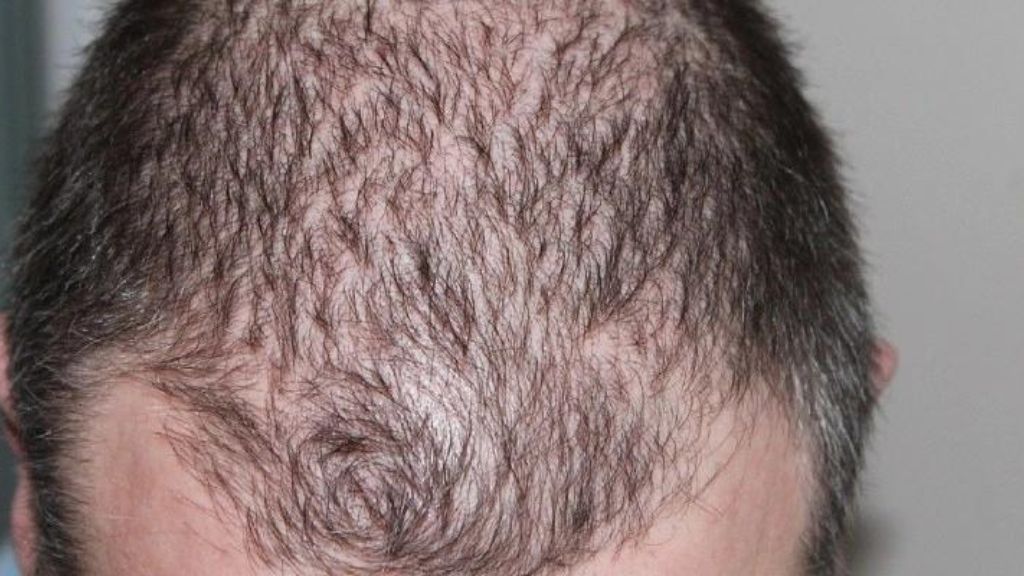 Queda de Cabelo